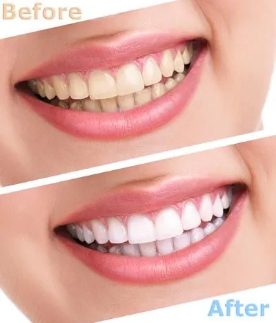 before and after results of teeth whitening services offered at Ember Dental Arts